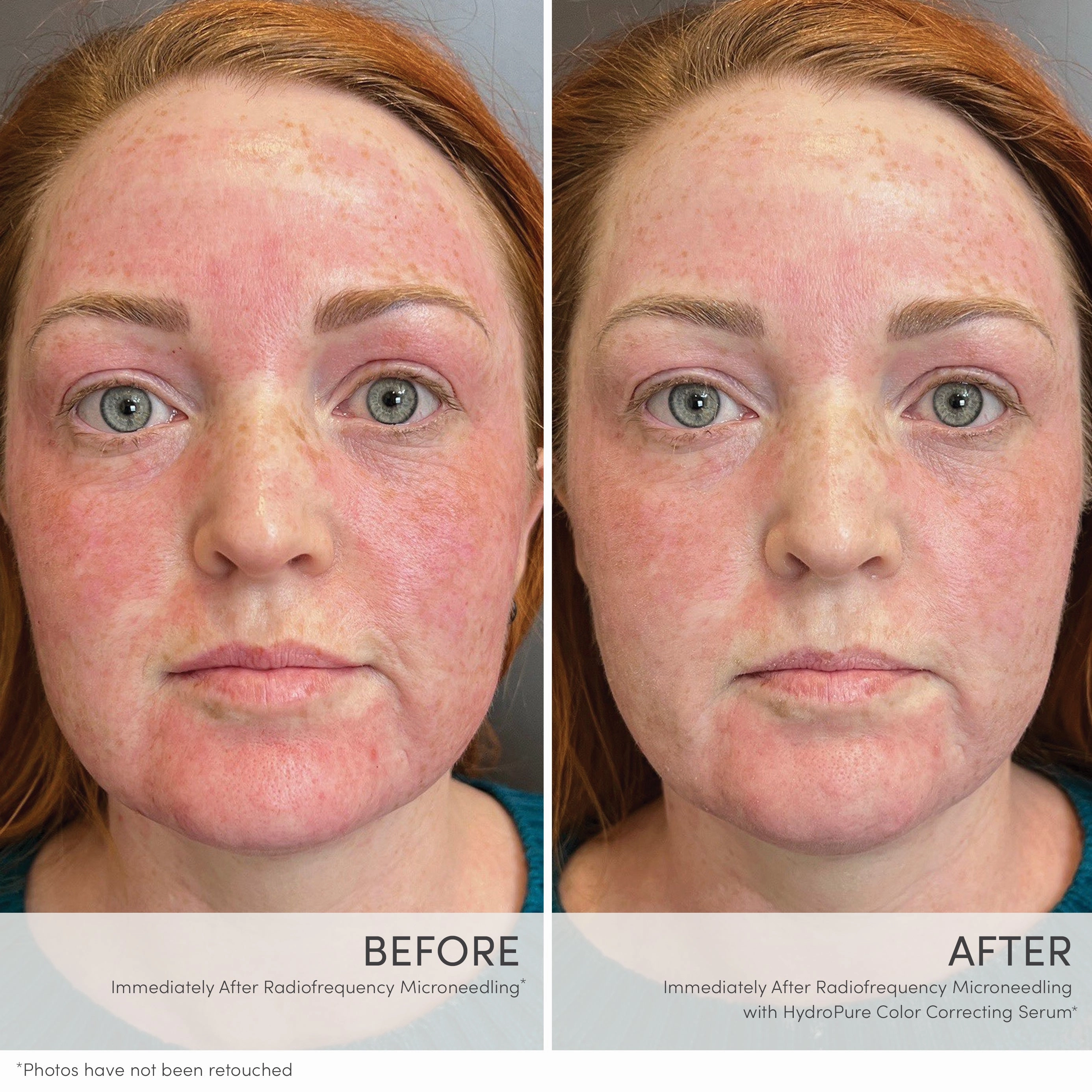 HydroPure™ Color Correcting Serum with Hyaluronic Acid & CoQ10